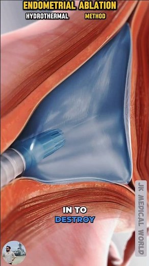Endometrial Ablation (Hydrothermal Method) | 3D Animation Explained🤯😲#3danimation #foryou #trending