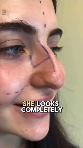This Shocking Nose Job Changed Her Entire Face – You Won’t Believe the Before vs After! Check in Comments! 👇👇👇 | Beautiful World