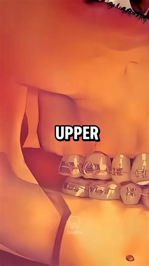 What a Crossbite Really Does to Your Teeth 😬 #oralhealth