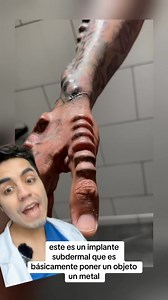 218K views · 61 reactions | Implante subdermal  #piercings | Doctor Gabriel Aedo Dermatólogo | Facebook