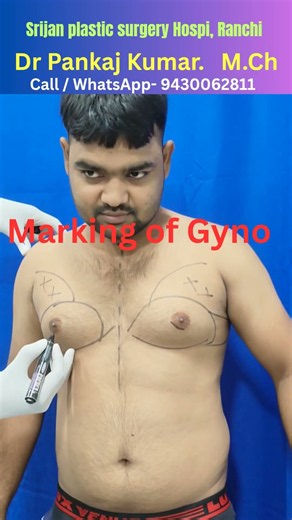 Steps of gynecomastia surgery| How to correct gynecomastia | Gynecomastia treatment in Ranchi #gyno