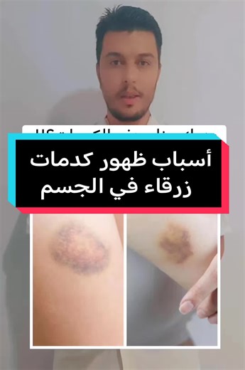 أسباب ظهور كدمات زرقاء في الجسم