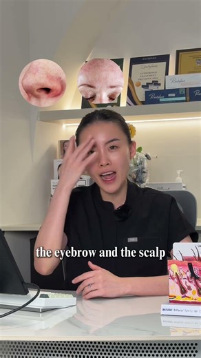 Seborrheic Dermatitis