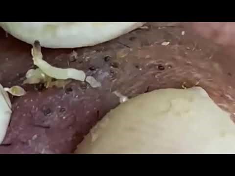 【角栓除去】しぶとい！大量のニキビを芯出しするのって気持ちいい／Blackhead Removal Show #acne #002 @0544 @0538