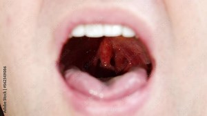 a man's mouth close-up. focus on the palatine uvula and mucous membrane of the throat. the concept of examination of the oral cavity, sore throat.