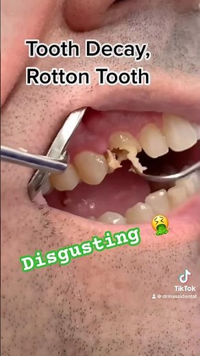 Rotten tooth disgusting 🤮
