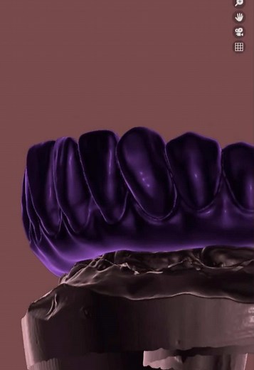 Diseño Dental Remoto: Taller de Exocad