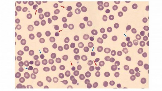 Glucose-6-Phosphate Dehydrogenase (G6PD) Deficiency - Hematology and Oncology - Merck Manual Professional Edition
