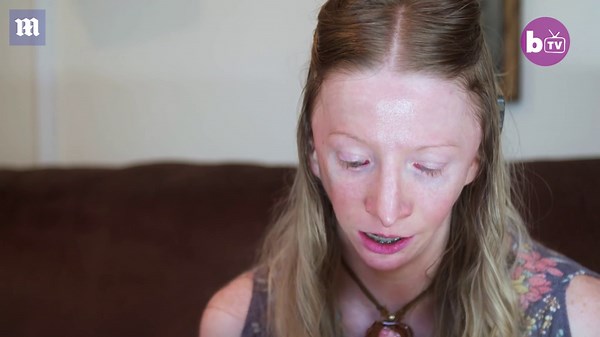 Inspiring young woman becomes advocate for Treacher Collins syndrome