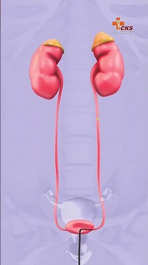 Advanced Kidney Stone Treatment at CKS Hospital