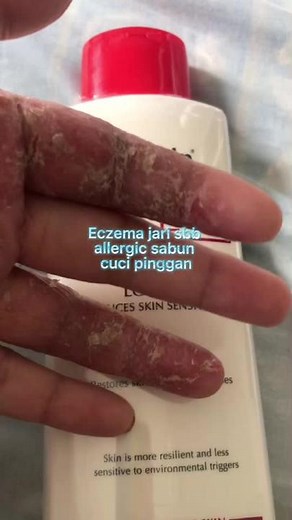 Cara Efektif Mengatasi Eczema dengan Eucerin PH5