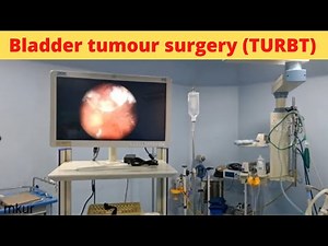 Bladder Tumour surgery (TURBT)