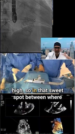 TTVR Deployment Technique: Azeem Latib on Coaxiality and Valve Positioning