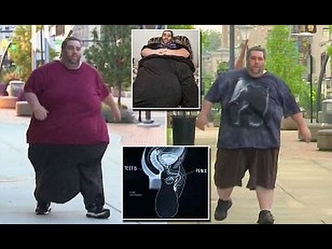 Dan Maurer 80lb scrotum has 14-hour surgery to remove the giant mass