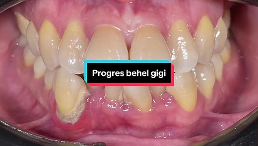 Understanding How Braces Work: Step-by-Step Progress of Crowded Teeth