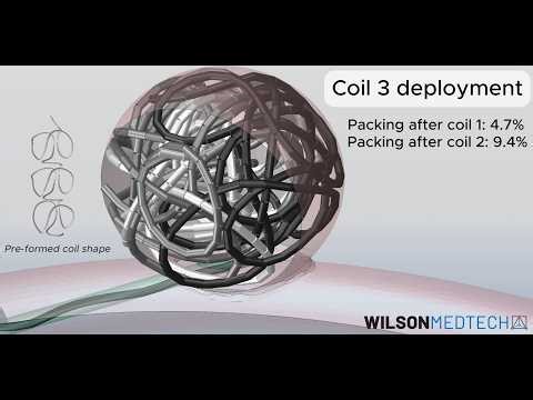 Embolization Coil Deployment and Packing into Saccular Aneurysm