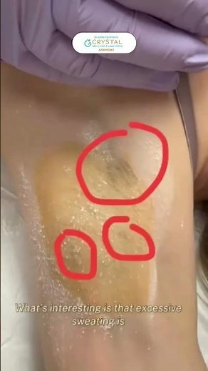 💧 Struggling with excessive underarm sweating?