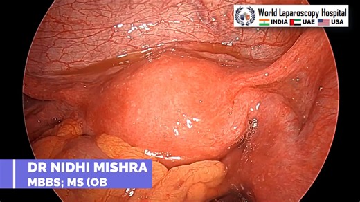 Laparoscopic Tubal Ligation by Dr. Nidhi Mishra | Minimally Invasive Sterilization Surgery Technique
