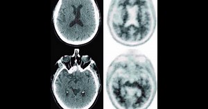MRI could be used to identify risk for dementia