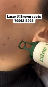 148K views · 558 reactions | Laser treatment for brown spots...