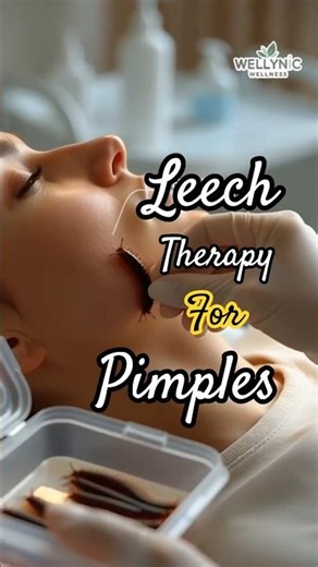 Can Leech Therapy Cure Pimples?#healthtips #wellness #skincare #skincareroutine