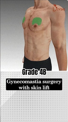 Gynecomastia Surgery Grade 4B with 360° 4Dx Contouring | Before & After Result