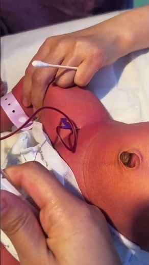 Life-Saving Precision: NICU Umbilical Line Placement! 👶🩺