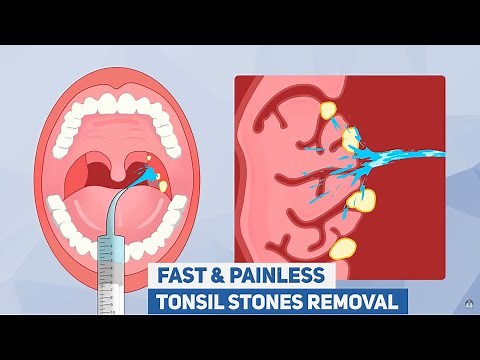 NEW Dr. Frederick's Original Easy Tonsil Stone Removal Kit