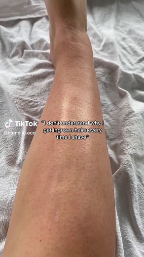 Prevent Razor Bumps and Ingrown Hairs with Reusable Safety Razor