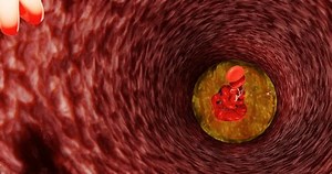 Fat clogs the arteries in the body. LDL. low-density lipoproteins.3d rendering. Chronic non-communicable diseases. Causes of heart disease. Sickness. Dangerous to health.