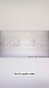 13K views · 89 reactions | 類  Look at this bizarre P wave! Visit the bookstore: https://www.masteryourmedics.com/pages/the-book-store #paramedicstudent #emtstudent #emtschool #emt #emtlife #paramedic #paramedicschool #paramedicos #paramediclife #paramedicscience #paramedical | Savage Paramedics | Facebook