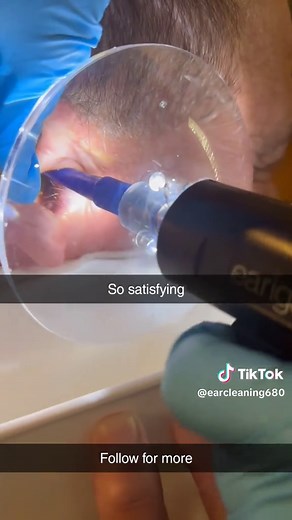 Satisfying Earwax Cleaning: A Step-by-Step Guide