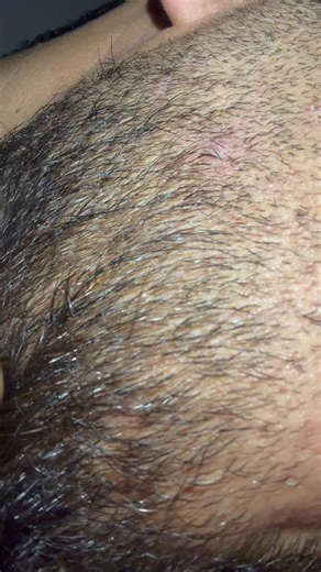 Clear skin hacks for ingrowns #ingrownhair #satisfying #ingrownhairremoval #beard #hair ￼