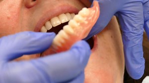 Old and new denture comparison