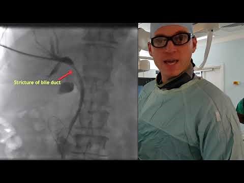 Cook biliary biopsy and stent