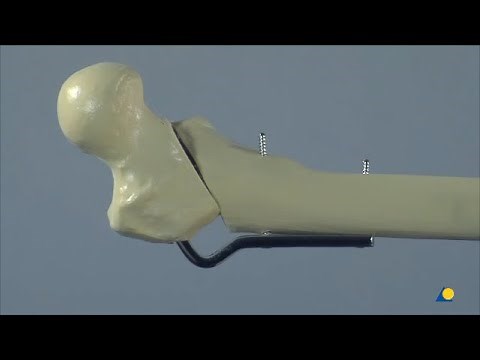 Femur, Proximal - Malunion of a 31A2 Fracture - Valgization and Extension Osteotomy and Fixation