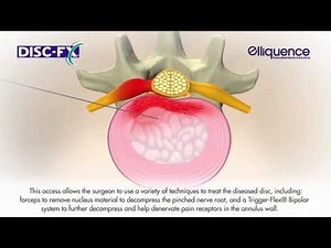 Disc FX Patient Animation