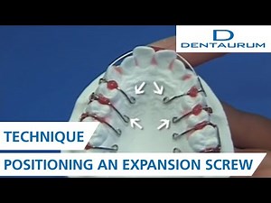 Positioning an expansion screw on the model for orthodontic appliance