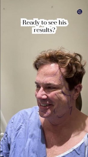 Natural Male Facelift| 3 Month Post-Op| Before & After