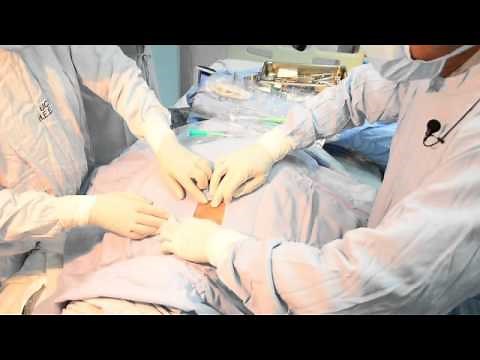 PROCEDIMIENTO TRAQUEOSTOMIA PERCUTANEA / TRACOE