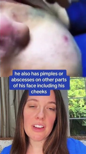 Severe Acne with Abscesses