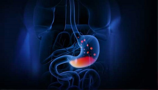 Wireless Esophageal pH Test (Bravo Test)