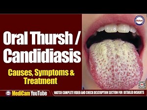 Oral Candidiasis / Thrush: Causes, Symptoms, and Treatment