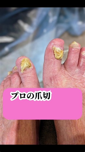 特養ホームでのプロによる足爪ケア