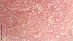 CLOSE UP, MACRO: Detail of dry silver scales covering red inflamed skin on an elbow affected by autoimmune disease called psoriasis. Skin allergy with severe symptoms. Dermatitis rash and ugly eczema