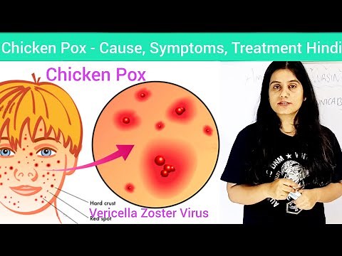 Chicken Pox - Cause, Symptoms, Diagnosis, Treatment Hindi | Vericella Zoster Virus,Chicken Pox Hindi