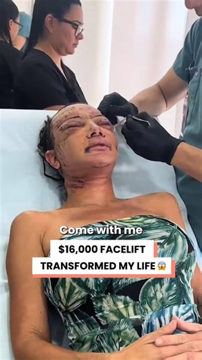 This $16,000 facelift transformed my life