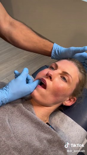 Deep tissue release of the lateral pterygoid muscle of the jaw from inside the mouth. #jawpain #jaw #tmj #tmjtreatment #tmjdisorder #tmd #tmjpainrelief #jawclick #intraoral #pterygoid #deeptissue #manualtherapy #chiropractor #vancouver @QubeCore Sports & Rehab