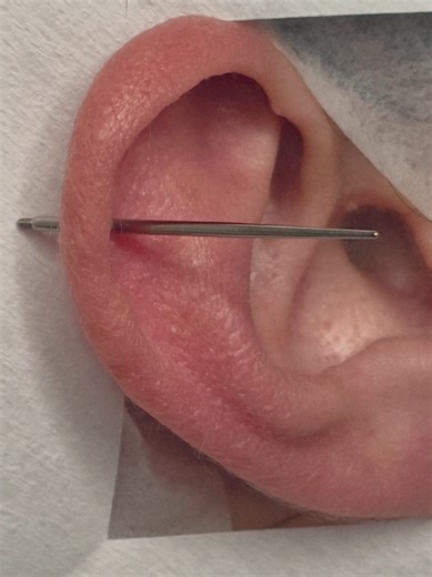 Helix Piercing Process Explained by Professionals