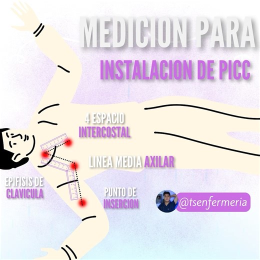 1.6K views · 19 reactions | Medición para instalar un PICC #enfermeria #nurse #enfermera #enfermero #medicine #medic #enfer #apuntesdeenfermeria #apuntesenfermeria | Todos Somos Enfermeria | Facebook